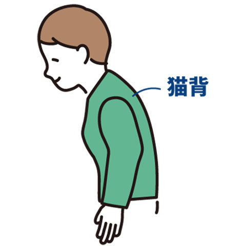猫背矯正