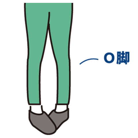 Ｏ脚矯正